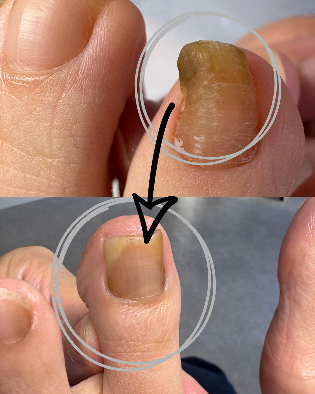 肥厚爪、変形爪 のサムネイル