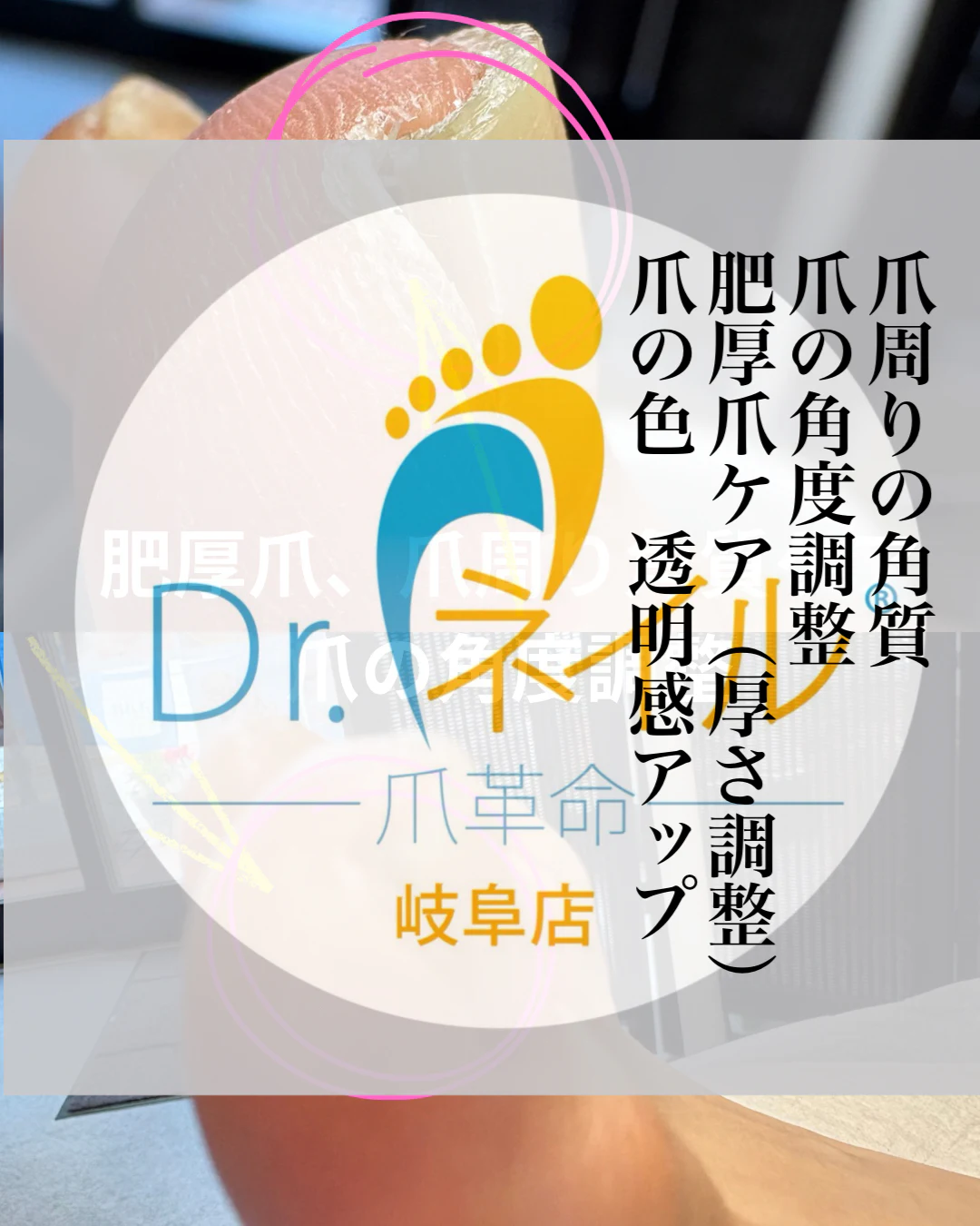 足の指先など足爪周囲の角質 のサムネイル