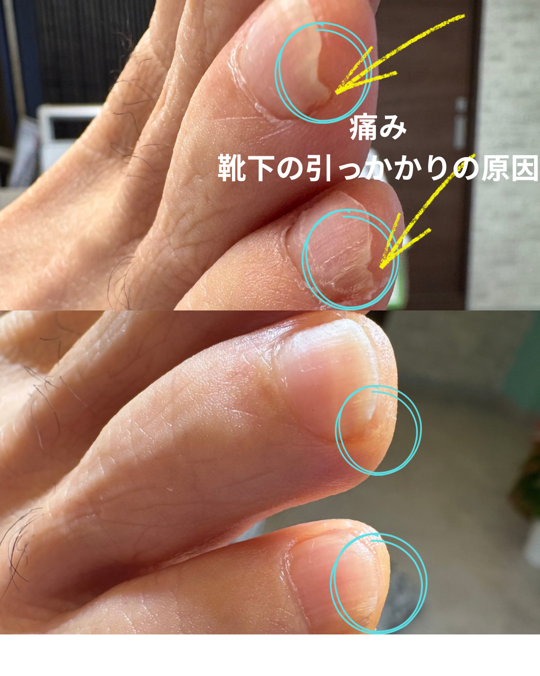 日頃、痛みで深爪セルフカット 痛みの原因は硬い角質と判断し角質ケア.png