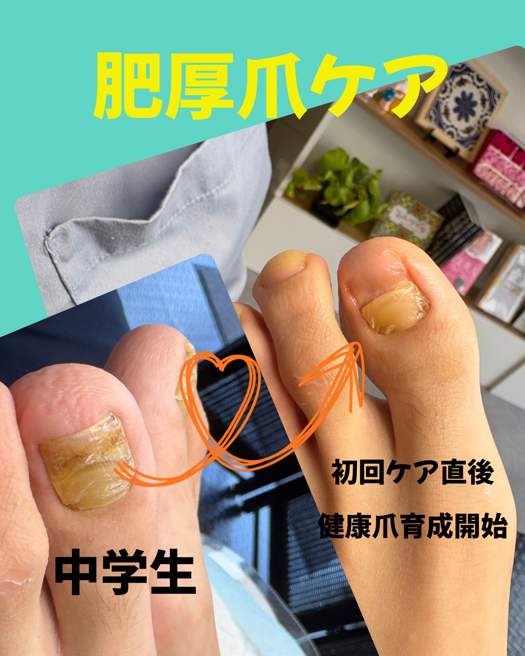 中学生の肥厚爪ケア のサムネイル