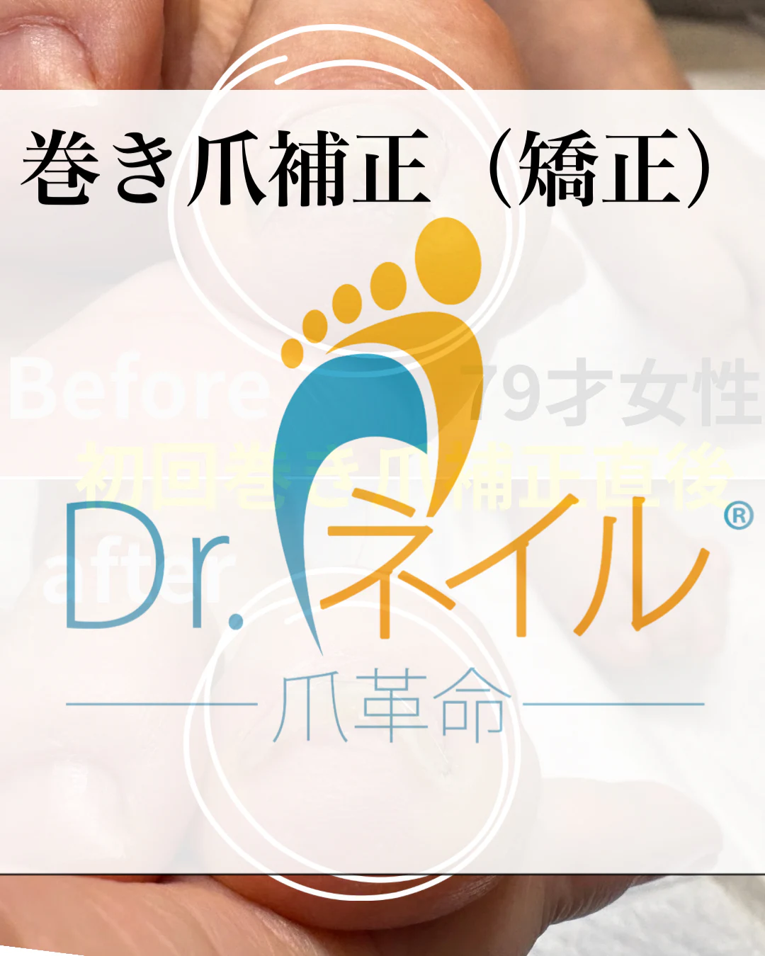 巻き爪（肥厚爪と爪周りの角質もあり）補正 のサムネイル
