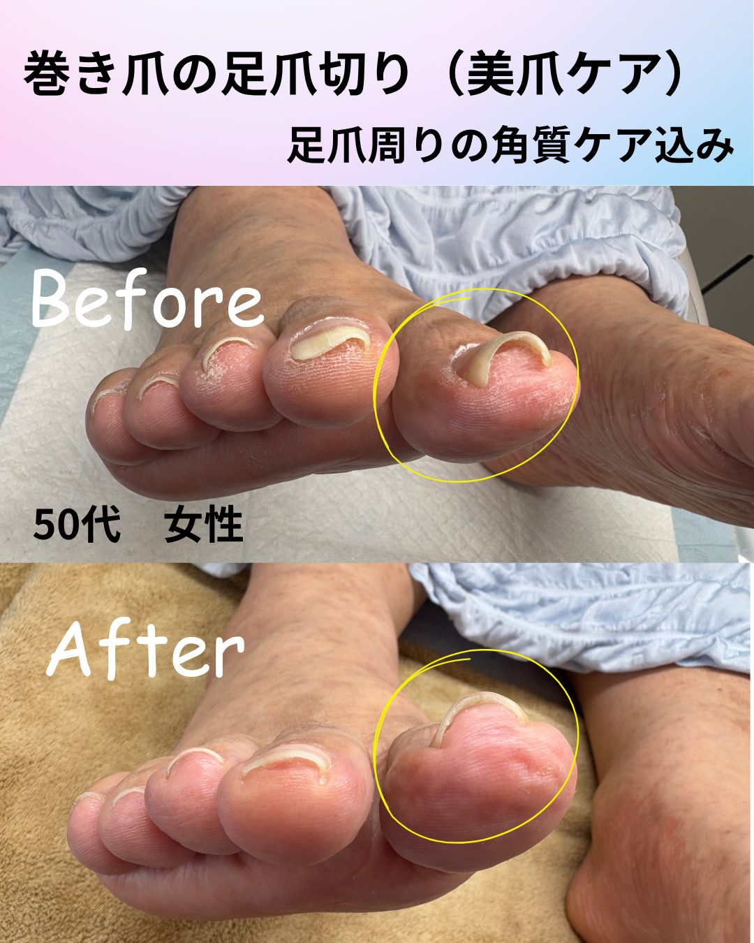 巻き爪の爪切り のサムネイル