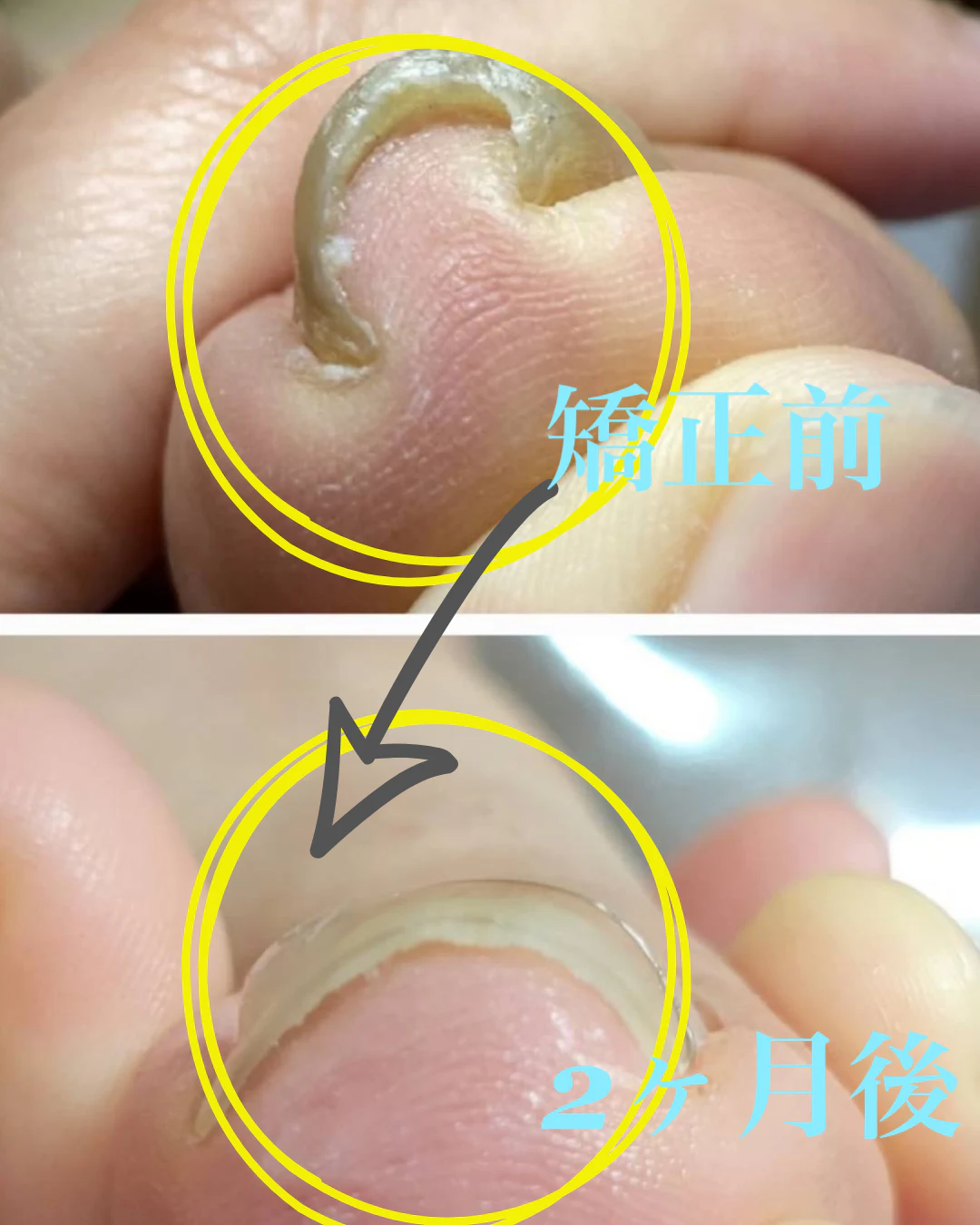 巻き爪補正 のサムネイル