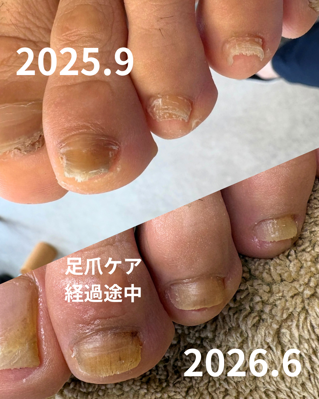 足裏角質ケア.png