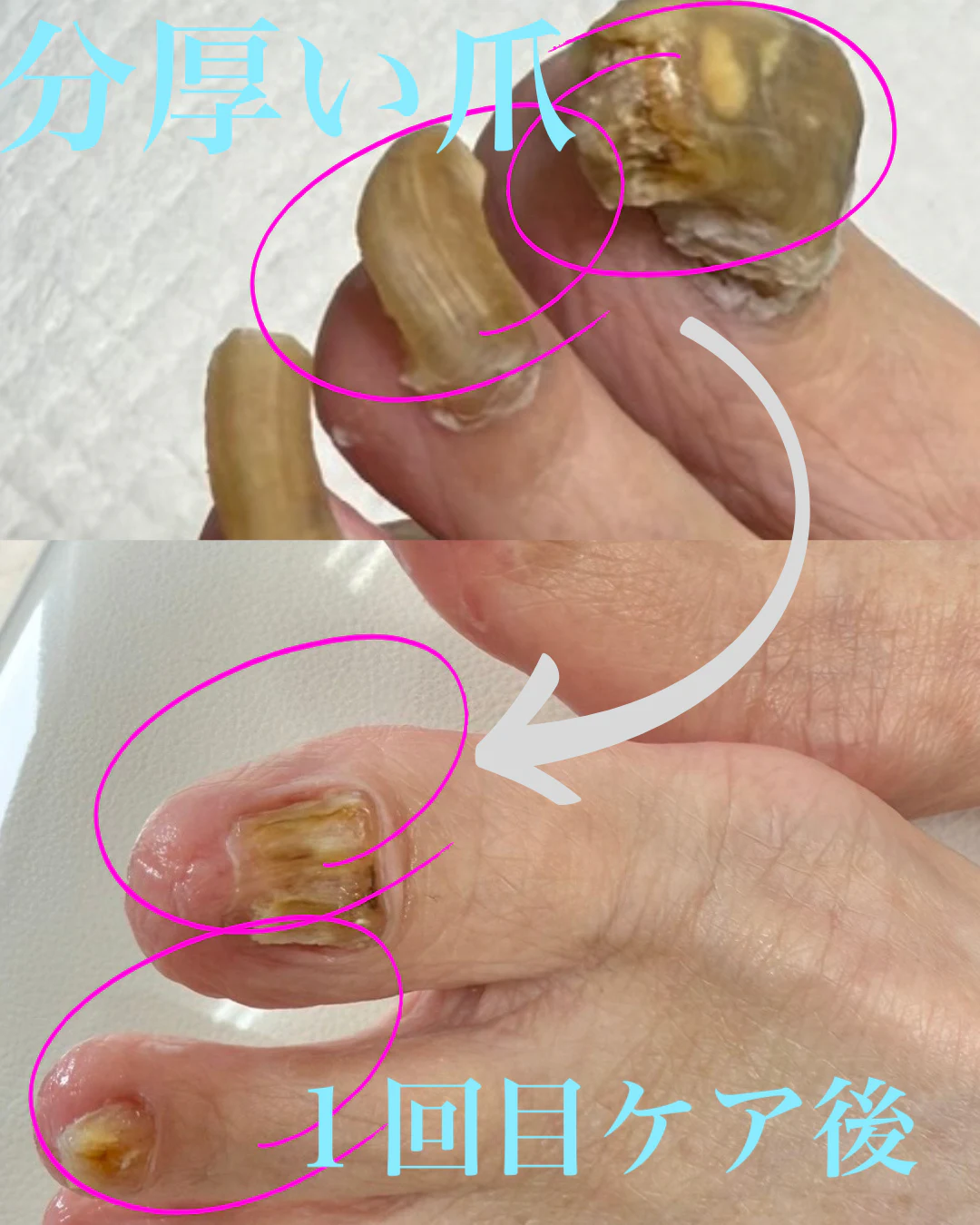 分厚い爪 のサムネイル