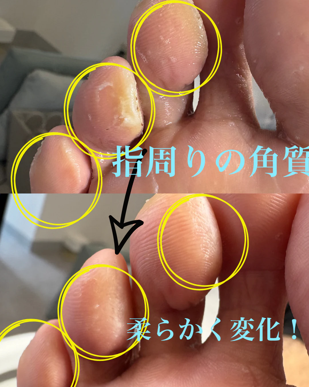 指周りの分厚い角質 のサムネイル