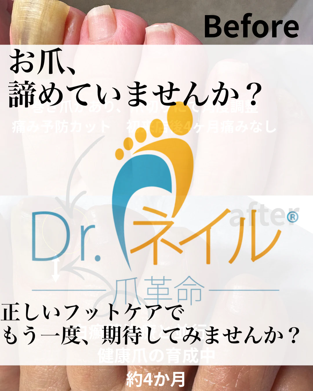 【正しいフットケアで諦めた爪をもう一度期待してみませんか?】 のサムネイル