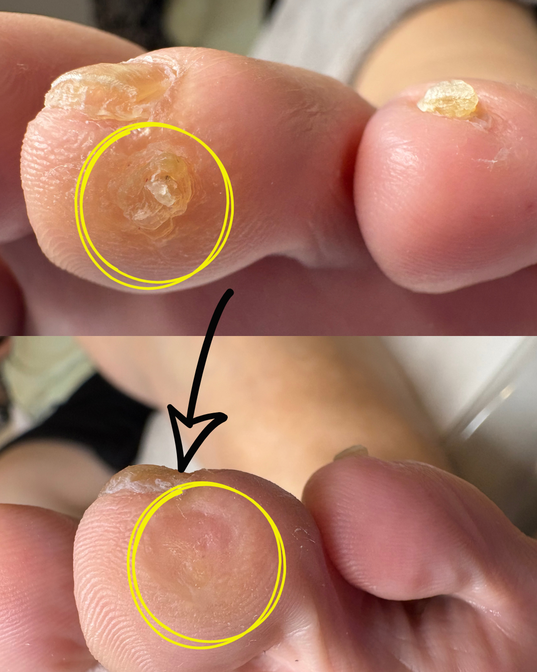 たこケア【胼胝(べんち)】 のサムネイル