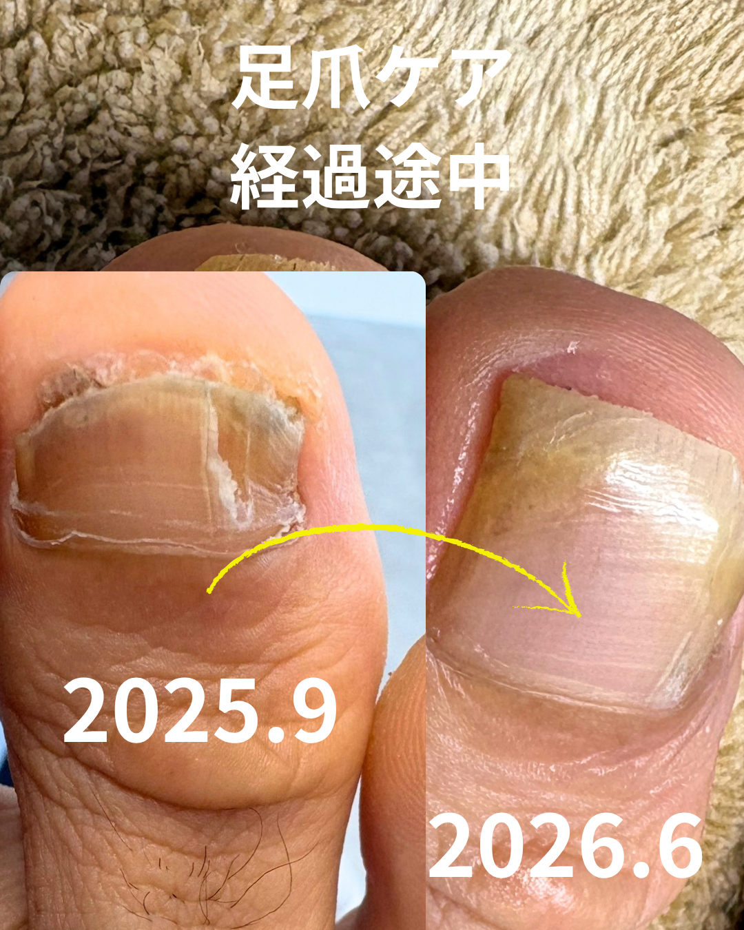 肥厚、割れ、伸びない、変形の足爪ケア経過 のサムネイル