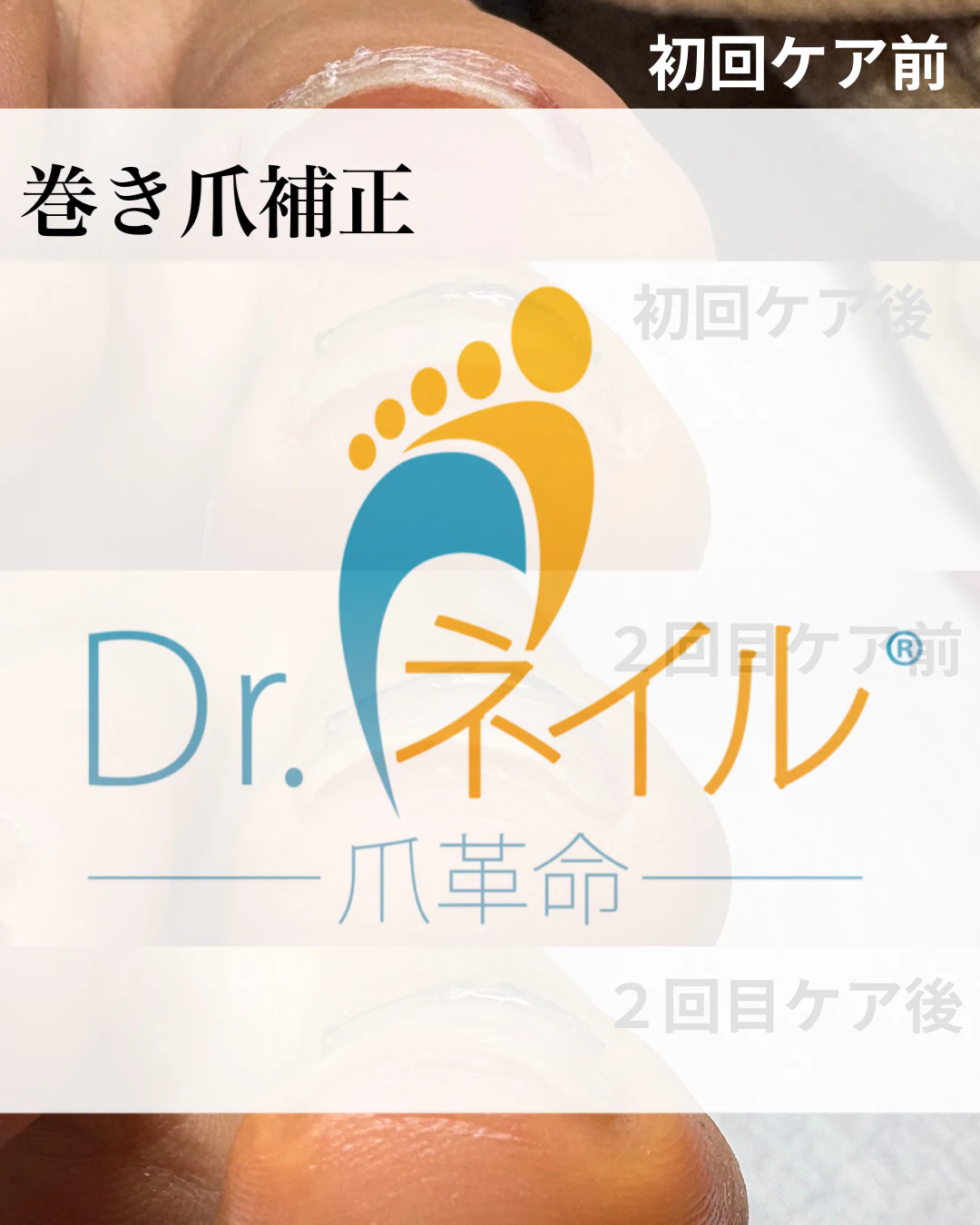 巻き爪補正 のサムネイル