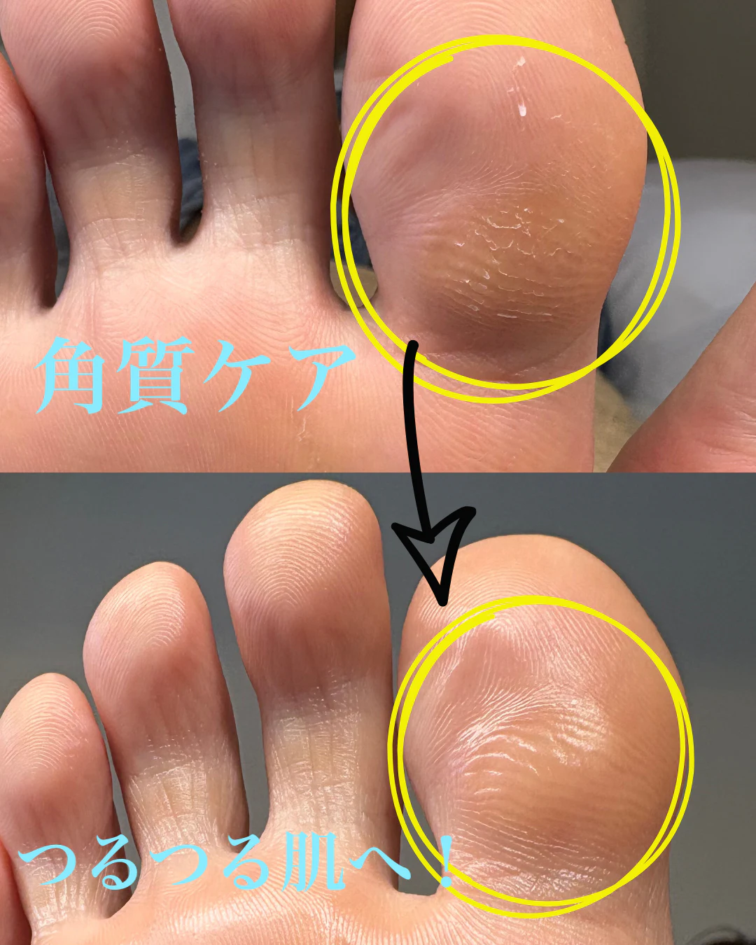 角質ケア のサムネイル